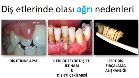 Diş etinde ağrı nedenleri