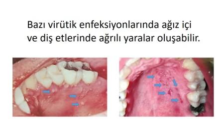 diş eti ağrısı oluşturan yaralar