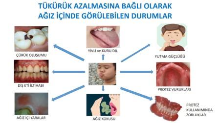 tükürük azalmasına bağlı olarak ağız içinde görülen durumlar