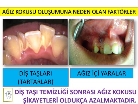 ağız kokusu oluşturan faktörler