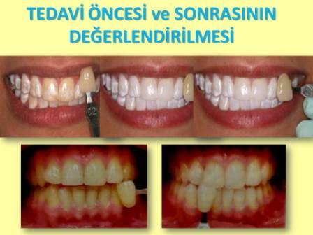 diş beyazlatma tedavisi öncesi ve sonrası değerlendirme