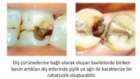 diş çürümesine bağlı diş etlerinde şişlik