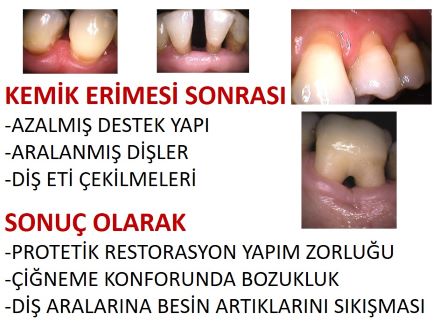 Diş eti çekilmesi sonuçları