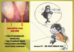diş eti iltihabı nedeni olan eklenti