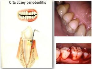 diş eti iltihabının ilk belirtisi olan diş eti kanaması