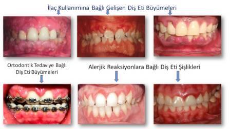 ilaç kullanımına bağlı diş etlerinde şişlik