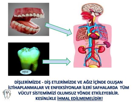 diş eti hastalıkları ile genel sağlığımız arasındaki ilişki