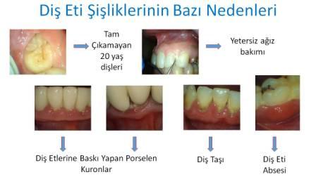 diş eti neden şişer