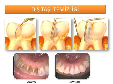 diş taşı temizliği nasıl yapılır?