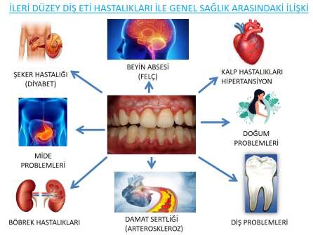 diş eti hastalıklarının vücudumuza etkileri