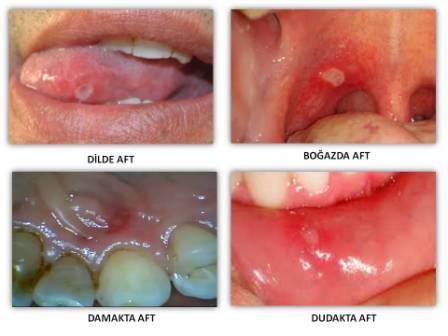 ağız içinde oluşan yaralar