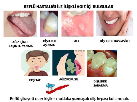 reflu hastalığında ağız içi bulgular