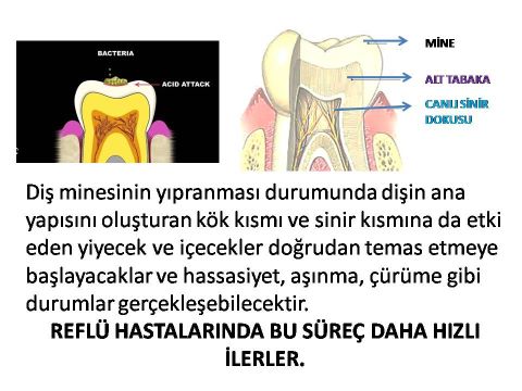 diş minesinde aşınma