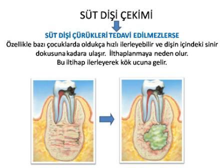 süt dişi çekimi