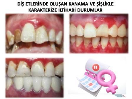 Menopozda diş eti kanamaları