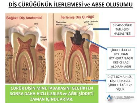 Diş çürüğü