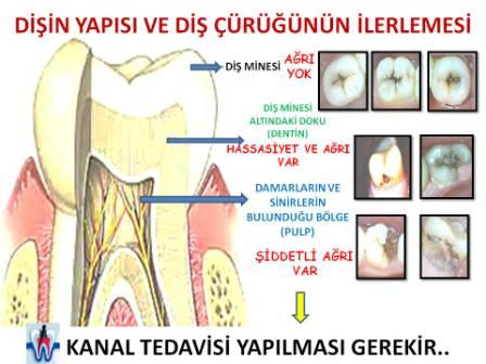 Kanal tedavisi yapılması gereken durumlar