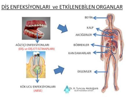 Dişteki iltihabın vücuda zararları