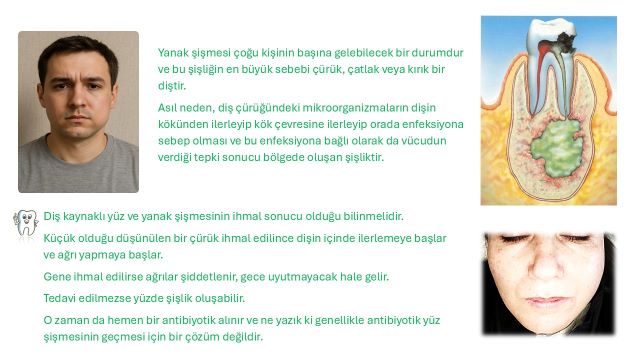 diş apsesi sonucu yüzde şişlik