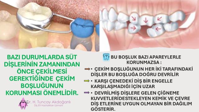 zamanından önce çekilen süt dişleri