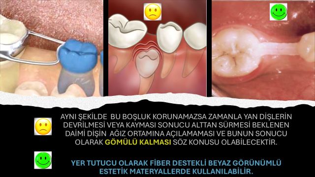 erken süt diş kaybı