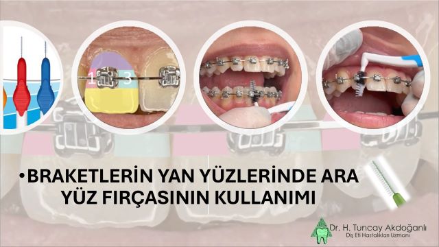 braketlerin yan yüzlerinde ara yüz fırçasının kullanımı ile ilgili fotoğraf