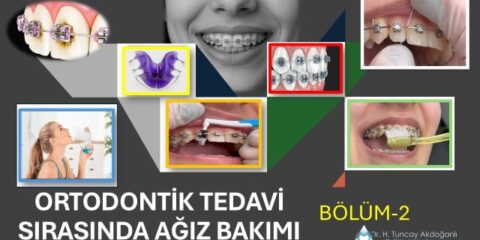 ortodontik tedavi sırasında ağız bakımı için detaylı anlatım