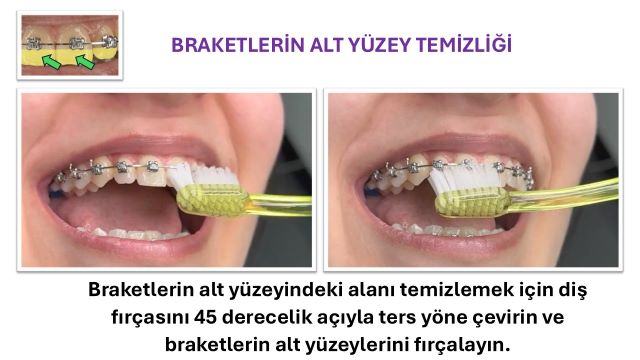 Diş teli takan bir genç dişlerini fırçalarken