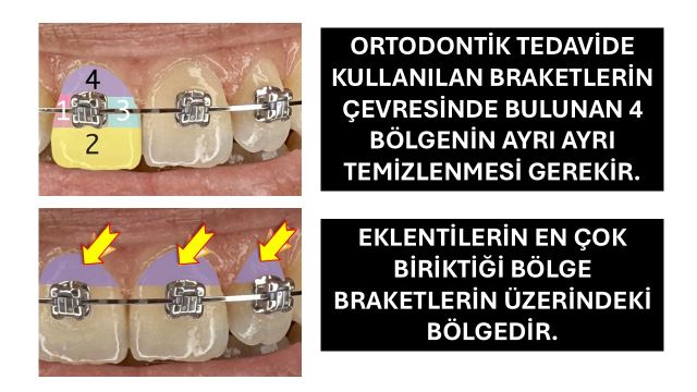ortodontik tedavide kullanılan braketlerin temizliği