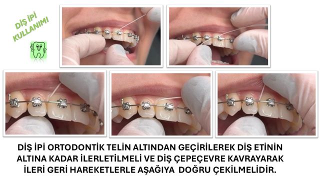 Ortodontik diş ipi ile diş arası temizliğinin yapılması