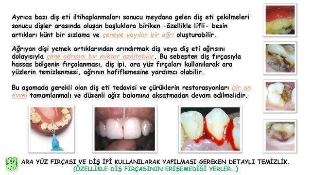 çene ağrısına neden olabilecek diş eti iltihabı