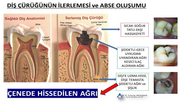 diş çürüğünün ilerlemesi sonucu yüzde oluşan şişlik