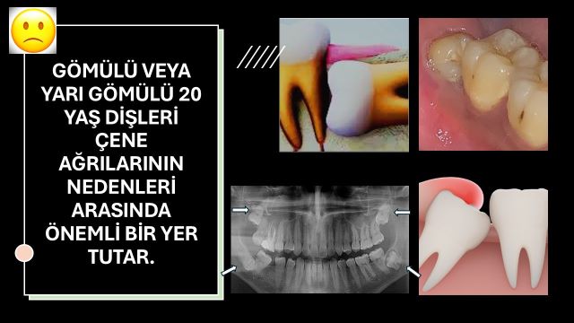 Çene ağrısına neden olabilecek gömülü diş