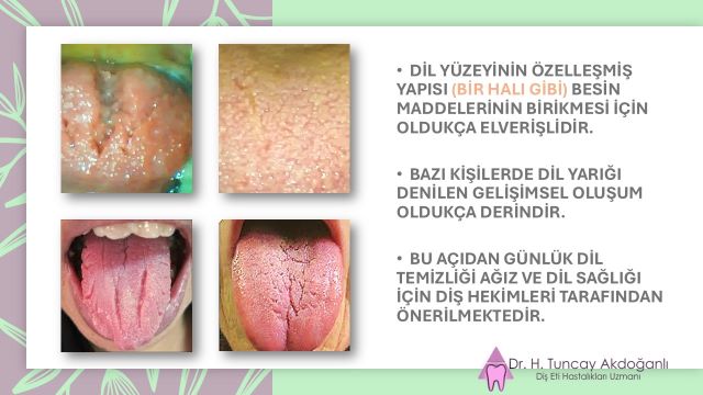 “Ağız içi tahrişi ve dilde acı hissini gösteren detaylı görsel.”