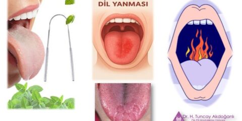 ağız ve dil yanması nedenleri ve öneriler görseli