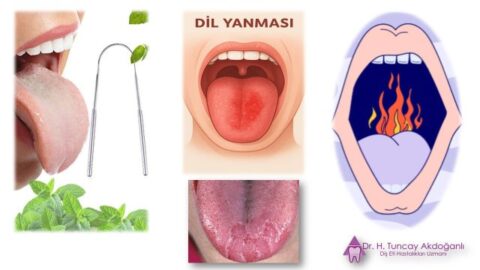 ağız ve dil yanması nedenleri ve öneriler görseli