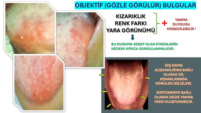 “Dilde kızarıklık ve yüzeyde belirgin tahriş görülen yakın çekim dil fotoğrafı.”