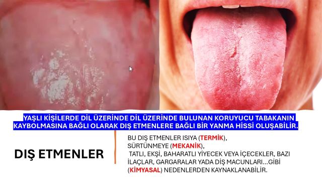 dilde yanma oluşturan nedenleri anlatan bir görsel
