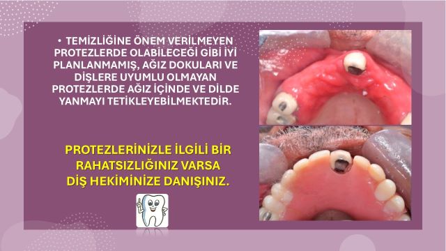 hatalı yapılmış bir protezin ağızda oluşturduğu yanma görseli