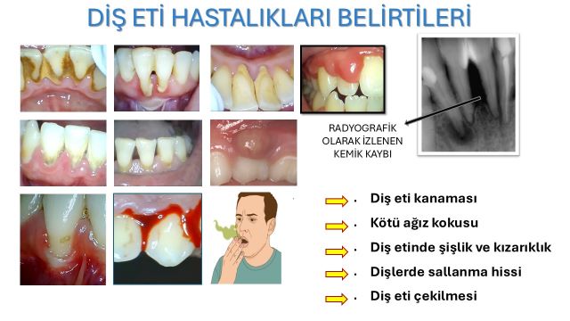 diş eti hastalıklarının çeşitli belirti ve bulguları detaylı gösteren fotoğraflar