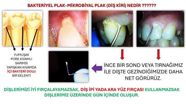 diş eti kanamalarına neden olan etkenlerle ilgili fotoğraf