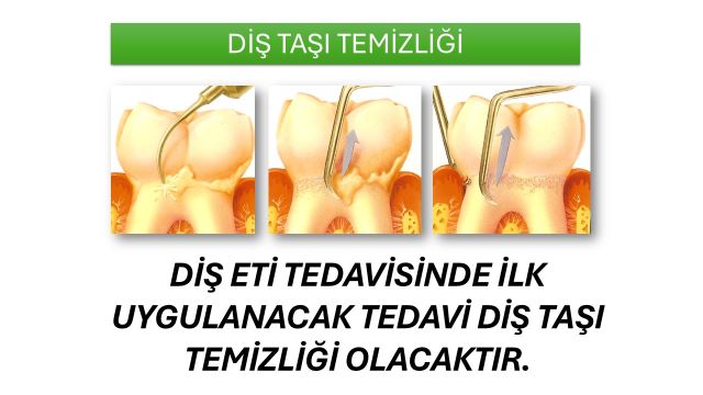 diş eti sağlığı için uygulanacak ilk tedavi olan diş taşı temizliğini anlatan görsel