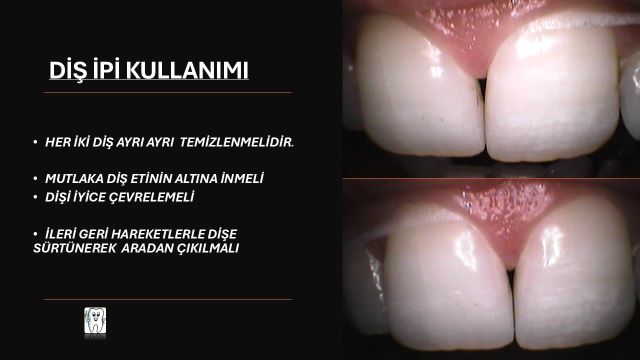 diş eti sağlığı açısından diş ipinin kullanımını anlatan fotoğraf