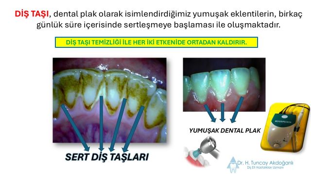 diş etine ne iyi gelir sorusuna, diş taşı temizliği yapılması önerisi ile ilgili bir görsel


