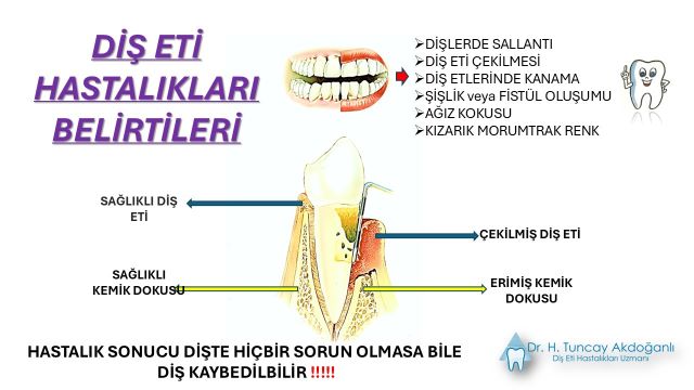 Diş kök iltihabının diş kökü ve çevre dokularda oluşturduğu enfeksiyonun şematik gösterimi