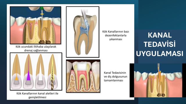 Diş kök iltihabı tedavisinde uygulanan kanal tedavisi işleminin aşamaları