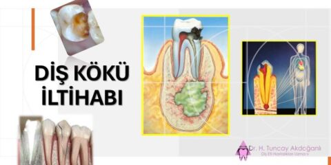 Diş kökü, sinir dokusu ve kök ucunda oluşan iltihabın detaylı diş anatomisi çizimi