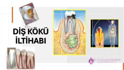 Diş kökü, sinir dokusu ve kök ucunda oluşan iltihabın detaylı diş anatomisi çizimi