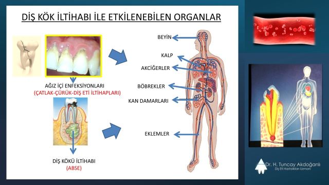 Diş kök iltihabının ve çürük ve diş eti hastalıklarının ilerlemesiyle etkilenbilecek organlar.