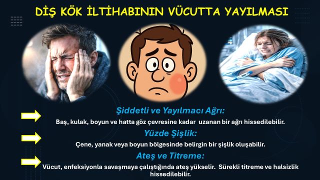 Diş kök iltihabına bağlı diş ağrısı, şişlik ve hassasiyet belirtilerini gösteren görsel